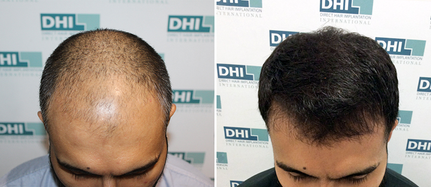 DHI before & after hair transplant results